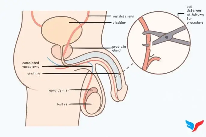 Vasectomy Diagram